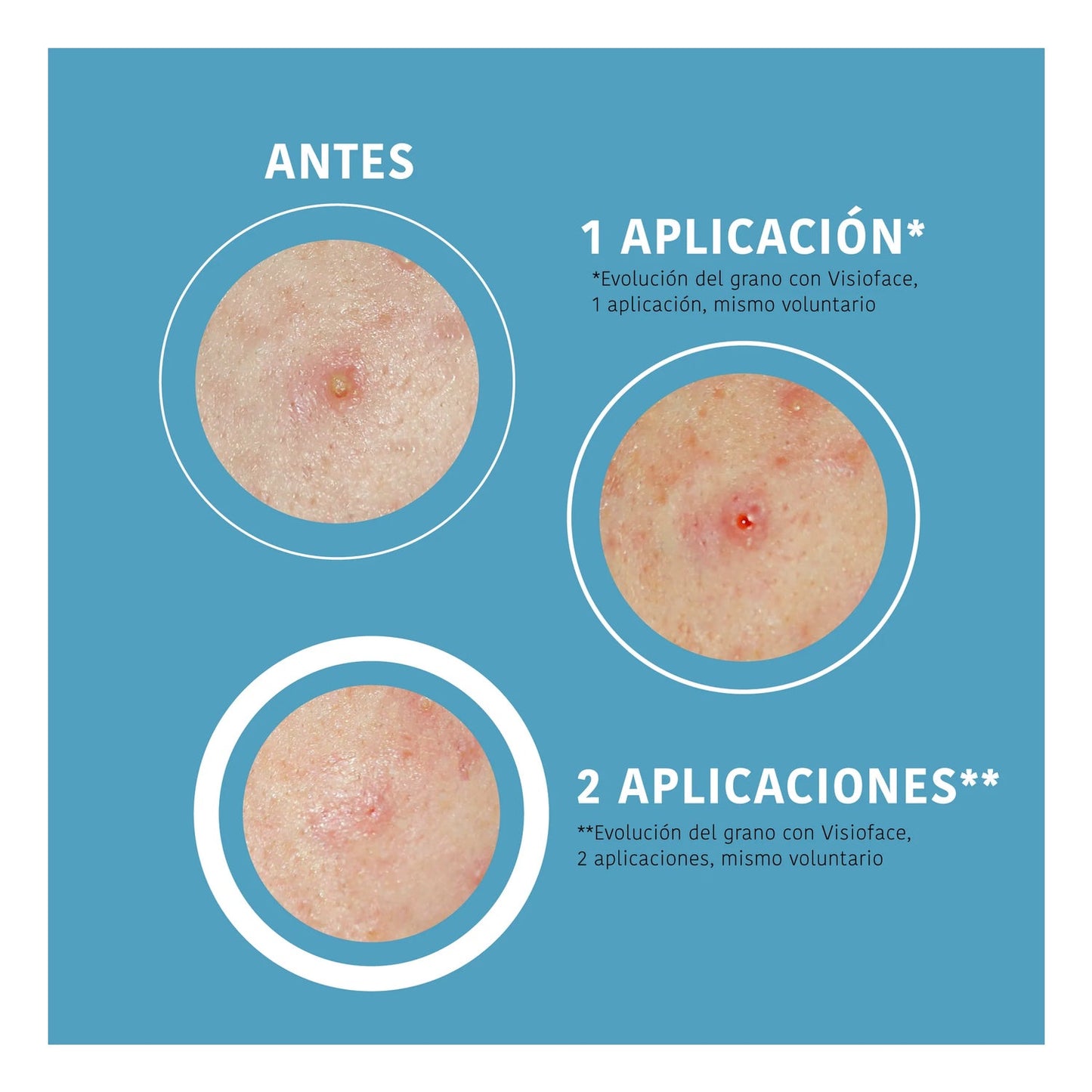 Iroha Nature Parches SOS Granos para Acné Cara y Cuerpo 18uds