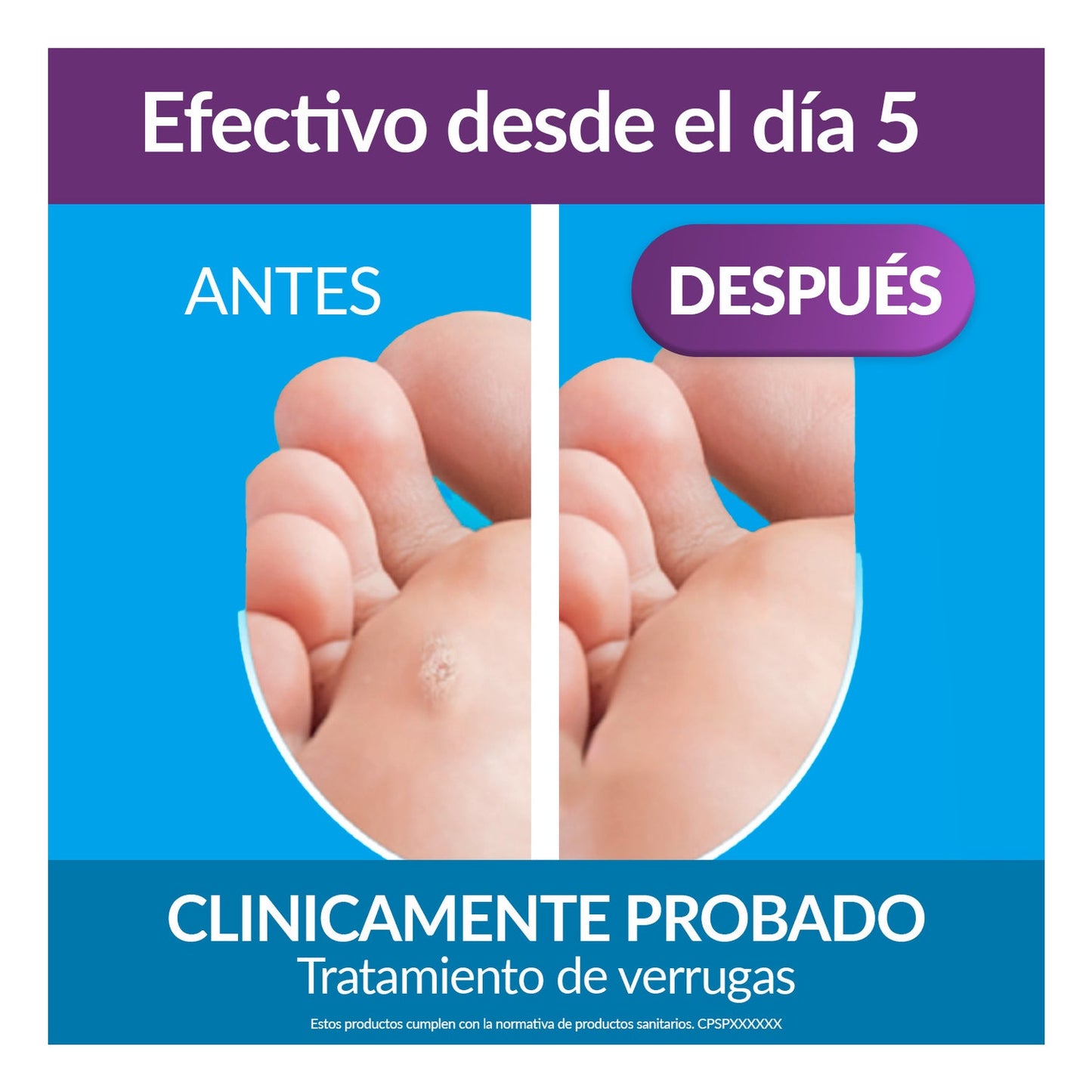 Excilor Verrugas Duo Power 10ml Crio + 1,5g Ácido