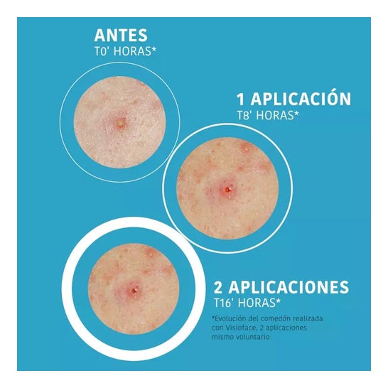 Iroha Nature Parches SOS Granos para Acné Cara y Cuerpo 18uds