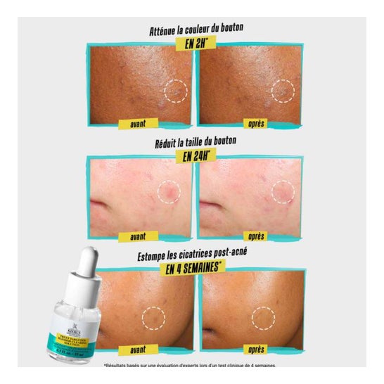 Kiehl'S Truly Targeted Acne-Clearing Solution 15ml
