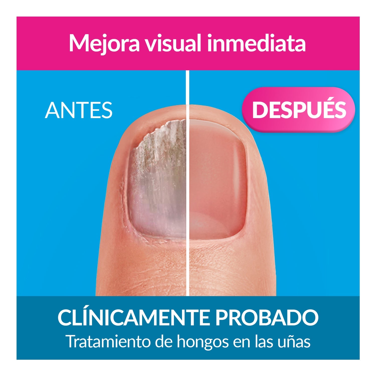Excilor Forte Color Tratamiento de Hongos de Uñas Nude 30ml