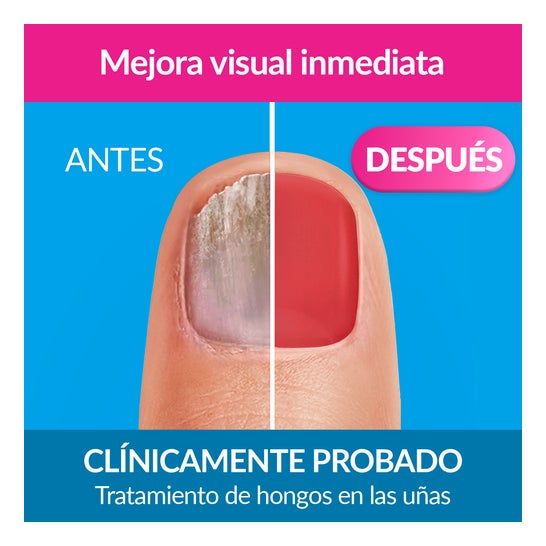 Excilor Forte Color Red Esmalte Tratamiento de la Micosis de las Uñas 30ml